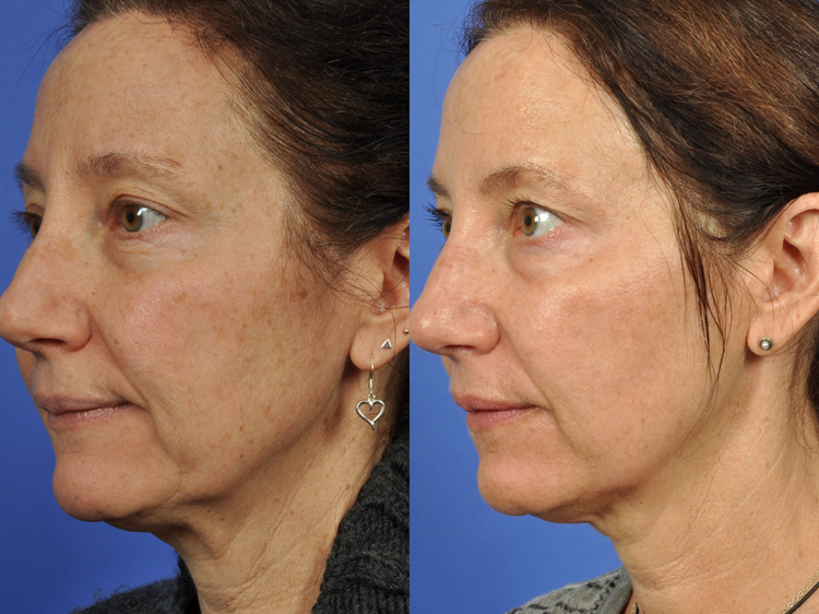 Microneedling What is microneedling Microneedling What is microneedling